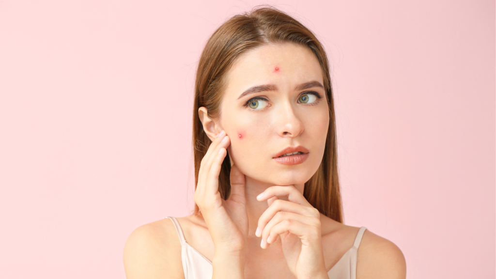 Como Tratar Acne: Dicas que vão te ajudar